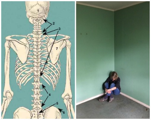 Collage Human Skeleton and woman sitting in a corner